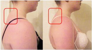 Muscle pad formation in cervical osteochondrosis