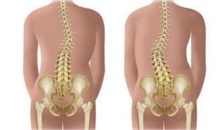 Non-structural scoliosis