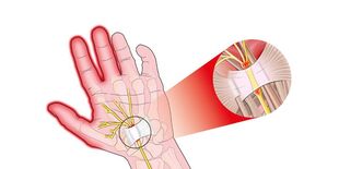 pain in finger joints with rhizarthrosis