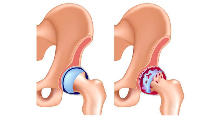 healthy, arthritic hip joint